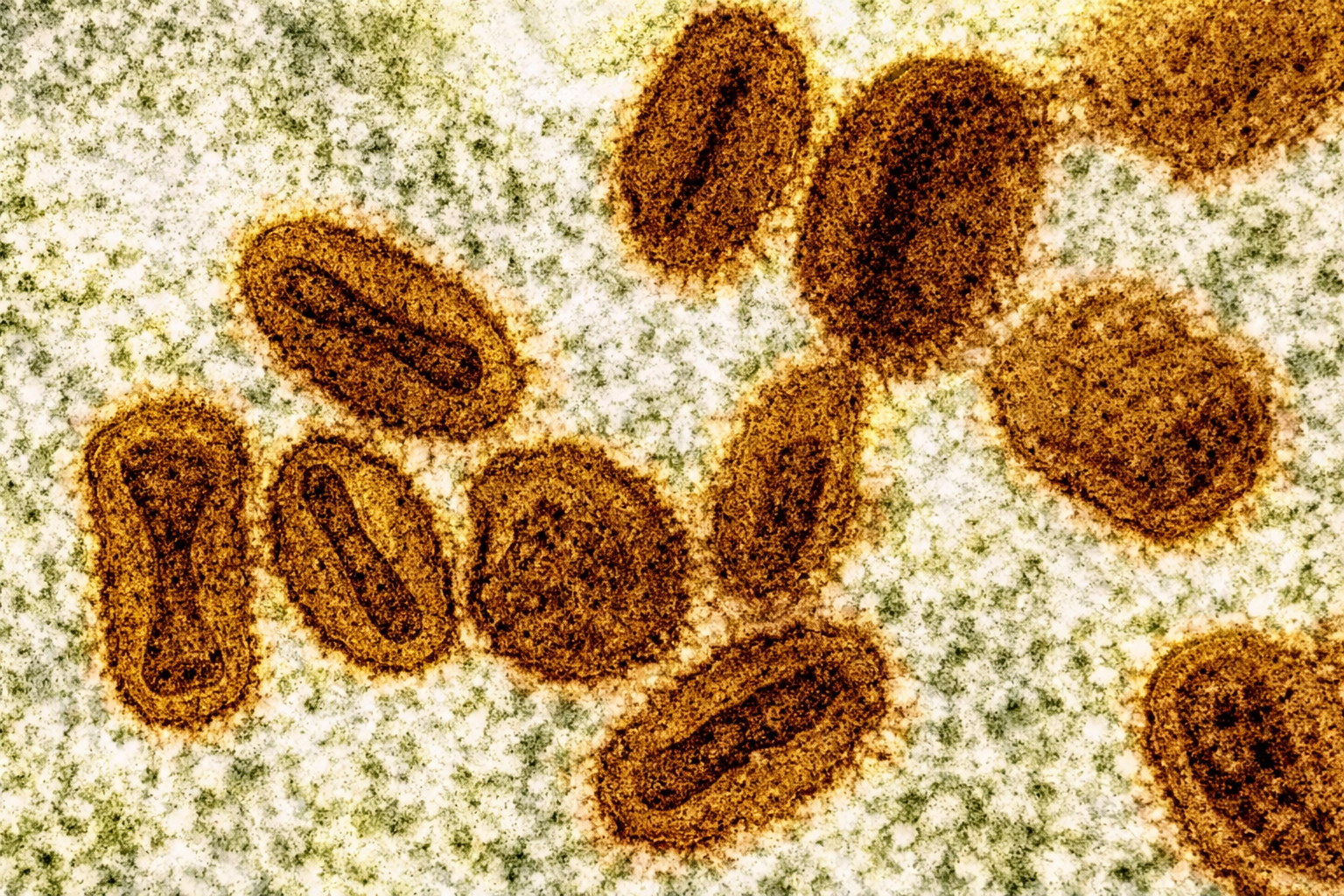 Ceará confirma primeiro caso de mpox do ano; país registra 140 infecções em 2026