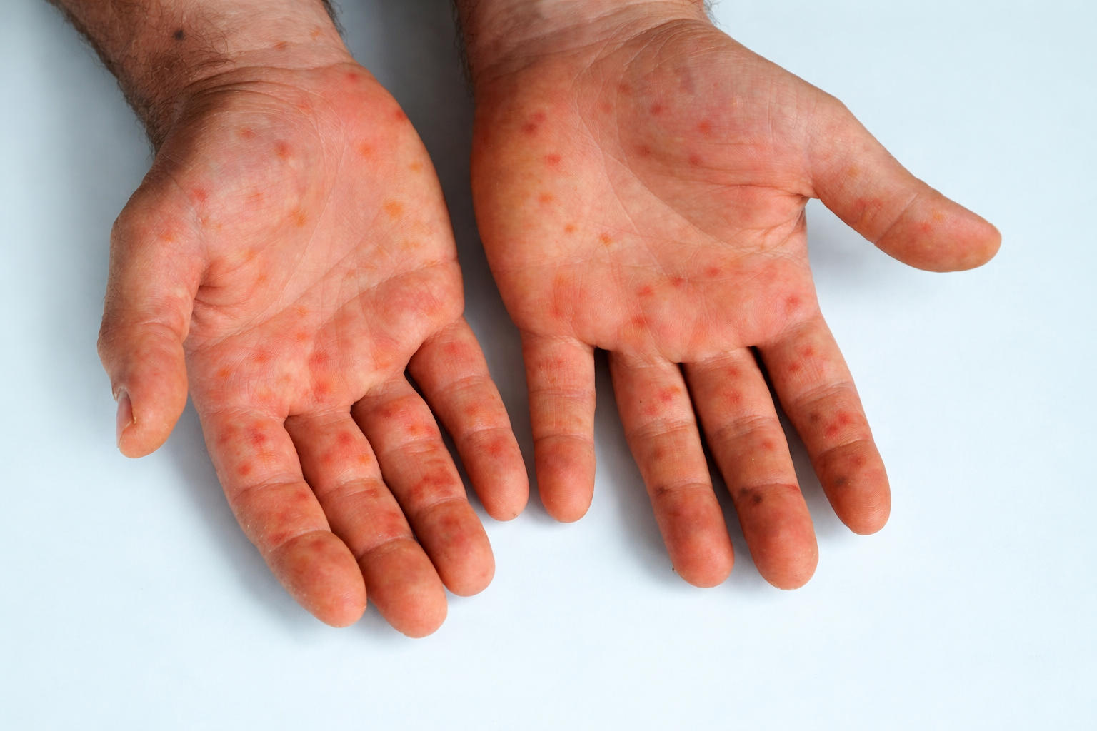 Ceará confirma segundo caso de mpox em 2026 com 8 suspeitas em investigação