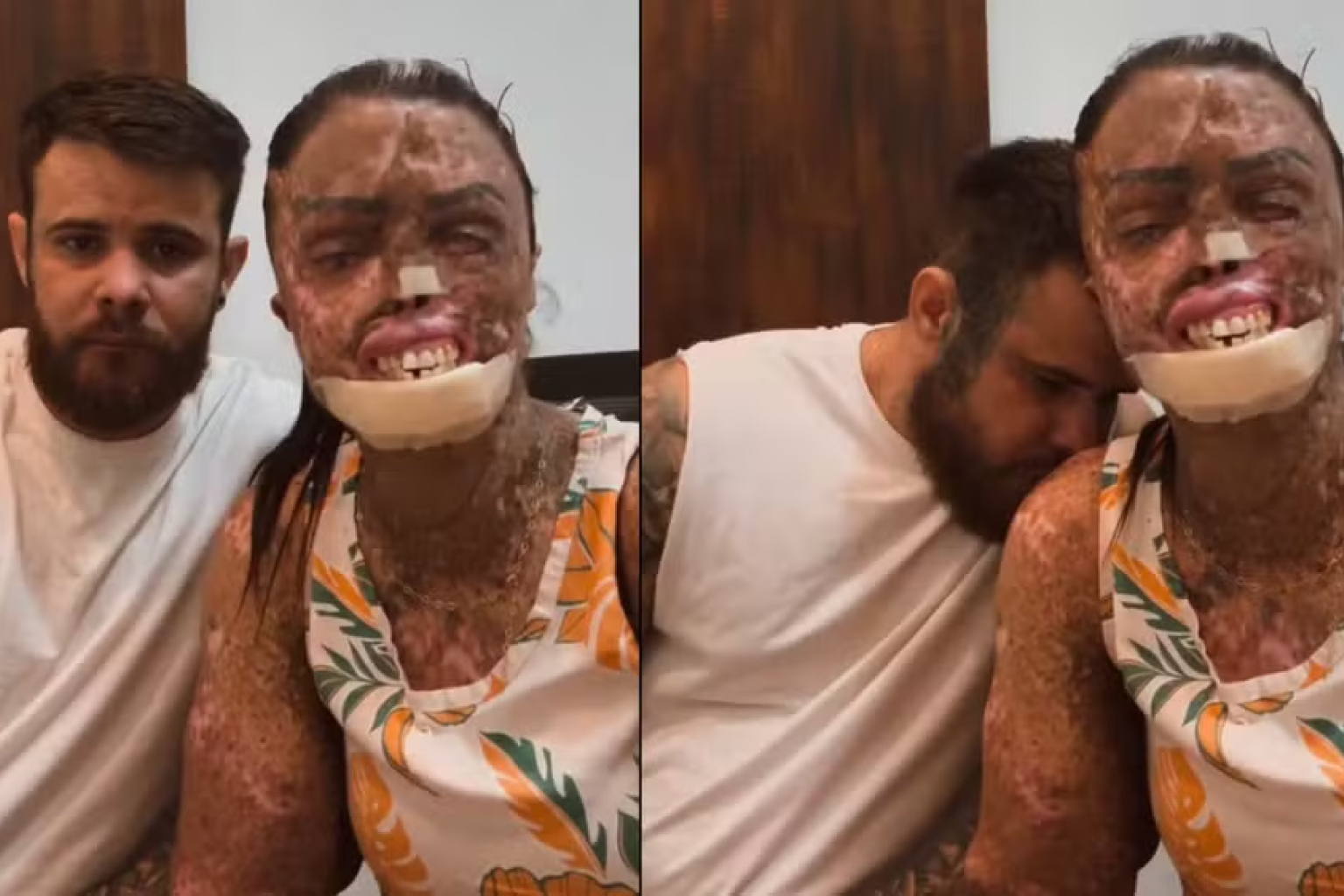 Influenciadora cearense com xeroderma pigmentoso revela metástase e diagnóstico terminal